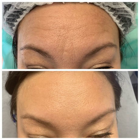 Botoks (toksyna botulinowa) na zmarszczki, usta, pod pachy