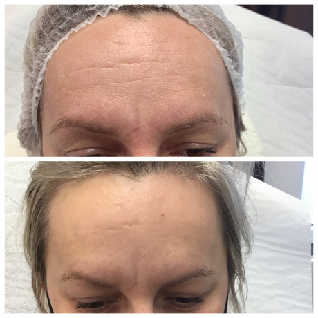 Botoks (toksyna botulinowa) na zmarszczki, usta, pod pachy