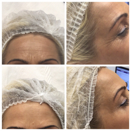 Botoks (toksyna botulinowa) na zmarszczki, usta, pod pachy