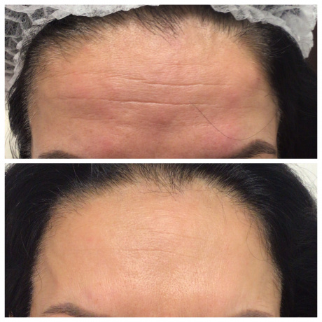 Botoks (toksyna botulinowa) na zmarszczki, usta, pod pachy