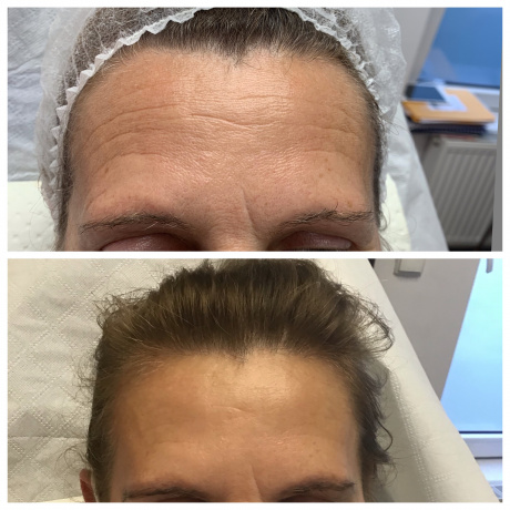 Botoks (toksyna botulinowa) na zmarszczki, usta, pod pachy