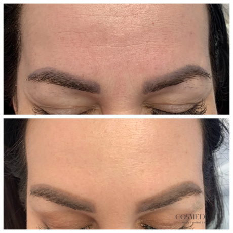 Botoks (toksyna botulinowa) na zmarszczki, usta, pod pachy